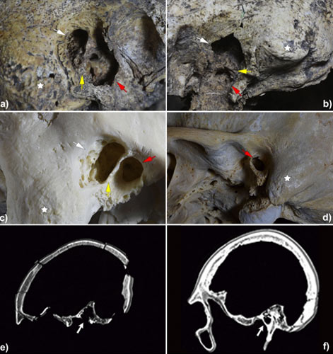 Computertomografische Aufnahmen (c und d) der beiden Schläfenknochen des Schädels (a und b), der vor über 5.000 Jahren in Spanien am Ohr operiert wurde.