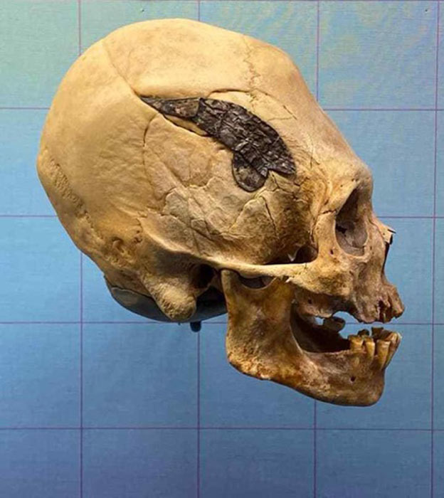 Das Museum in Oklahoma besitzt in seiner Sammlung einen frühen peruanischen Langschädel, der einer Schädeloperation unterzogen wurde