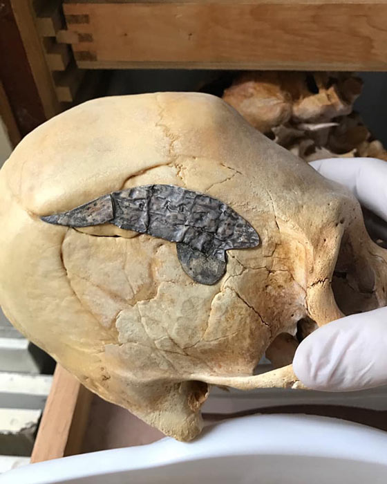 Länglicher peruanischer Schädel, der nach einer Kriegsverletzung vor etwa 2.000 Jahren operiert und mit einem Metallimplantat versehen wurde, um die Knochen zu verbinden