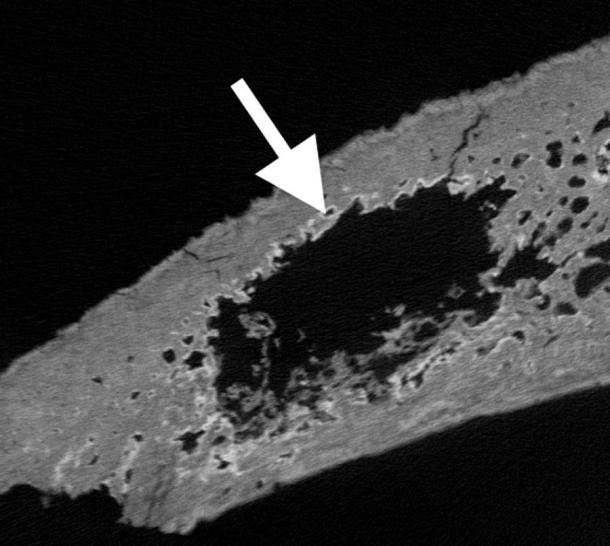 Im Rahmen ihrer Untersuchung des mittelalterlichen Krebses zeigt dieser CT-Scan eines Schädelknochens die darin versteckte Metastase. 