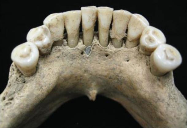Die Dentalprobe der Frau wurde mit Lapislazuli-Pigment gefunden.