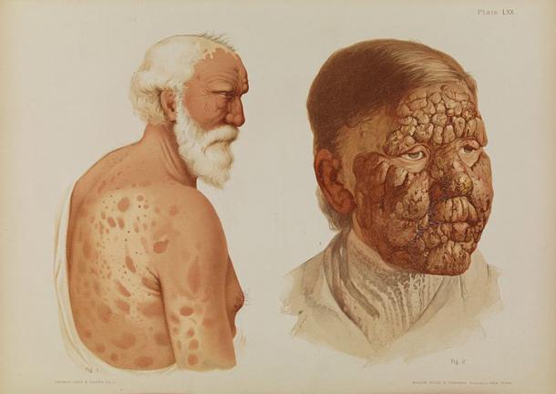 Illustration von älteren männlichen Patienten mit Lepra im Jahr 1889.