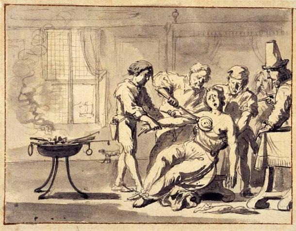 Illustration einer Brustamputation aus dem 17. Jahrhundert.