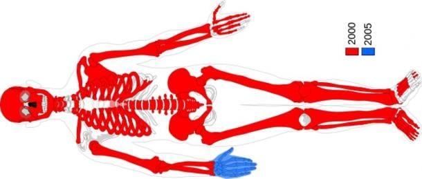 Mooras wiederhergestellte Körperteile. Im Jahr 2000 wurden rote und im Jahr 2005 blaue Teile im Uchter Moor, Niedersachsen, gefunden. Datierung 764 -515 v. Chr.
