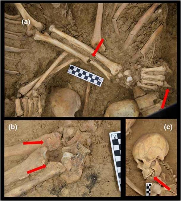 Pathologische und traumatische Spuren an den Skeletten der Liebenden: (a) Eine nicht verheilte Ulnarfraktur und das Fehlen eines Teils des vierten Fingers an der rechten Hand des männlichen Individuums. Bei dem weiblichen Skelett konnte eine leichte Entwicklung der Randosteophyten an den Lendenwirbeln festgestellt werden; (b) Osteophytose am distalen Ende der unteren Gliedmaßen des männlichen Individuums; (c) Antemortem-Zahnverlust bei dem weiblichen Individuum.