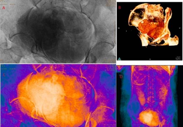 Scans zeigten, dass die Frau 26-30 Wochen schwanger war. (Journal of Archaeological Science) Die Forscher schreiben: "Dieser Fund ist der einzige bekannte Fall einer einbalsamierten schwangeren Person."