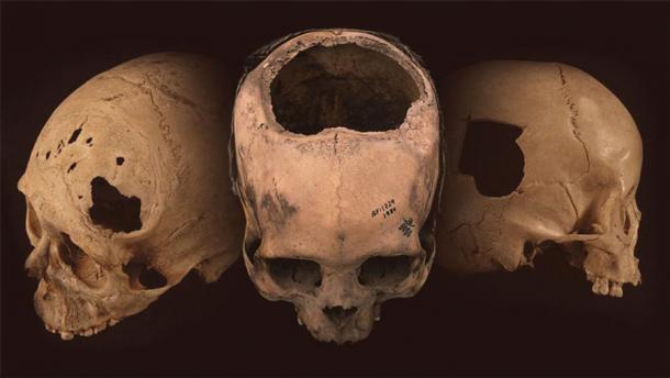 Antike Schädel mit Spuren der Trepanation, einer Art Schädelchirurgie, bei der ein markantes Loch in den Schädel geschnitten wurde, wofür es in Peru Beweise gibt.