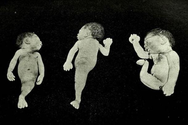 Bilder eines klinischen Falles von Sirenomelie oder Meerjungfrauen-Syndrom, über den 1902 in der Ausgabe des Maryland Medical Journal berichtet wurde. 
